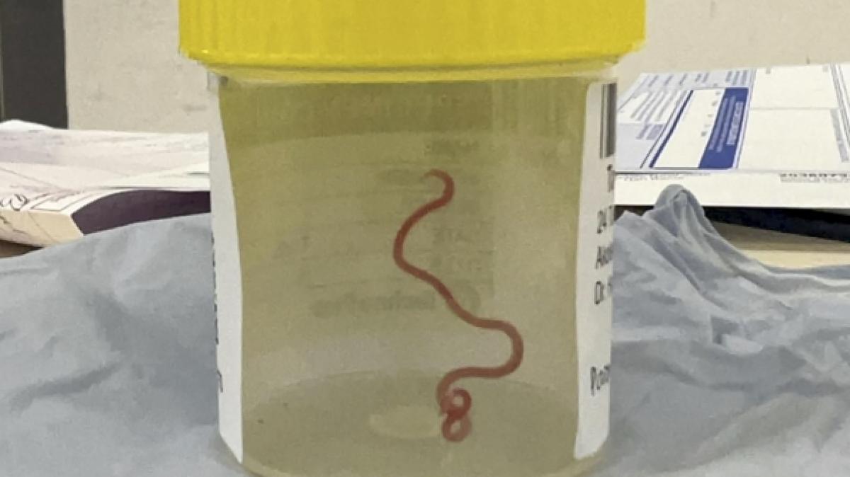 &Auml;rzte zogen jetzt einen acht Zentimeter langen Wurm aus dem Hirn einer Patientin. (Foto)