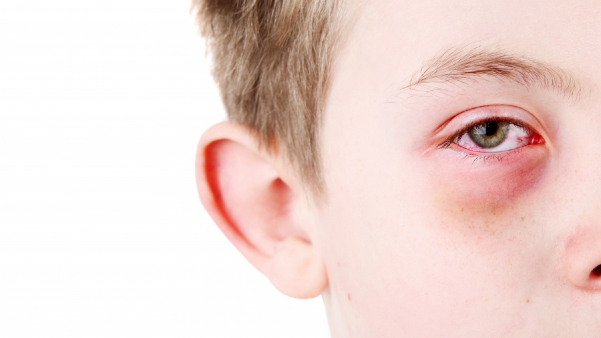 Ein neunj&auml;hriger Junge erblindete fast durch das "Covid-Auge". (Foto)