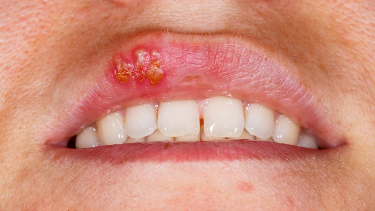 Laut einer neuen Studie k&ouml;nnen Herpesviren die Entstehung von Alzheimer beg&uuml;nstigen. (Foto)