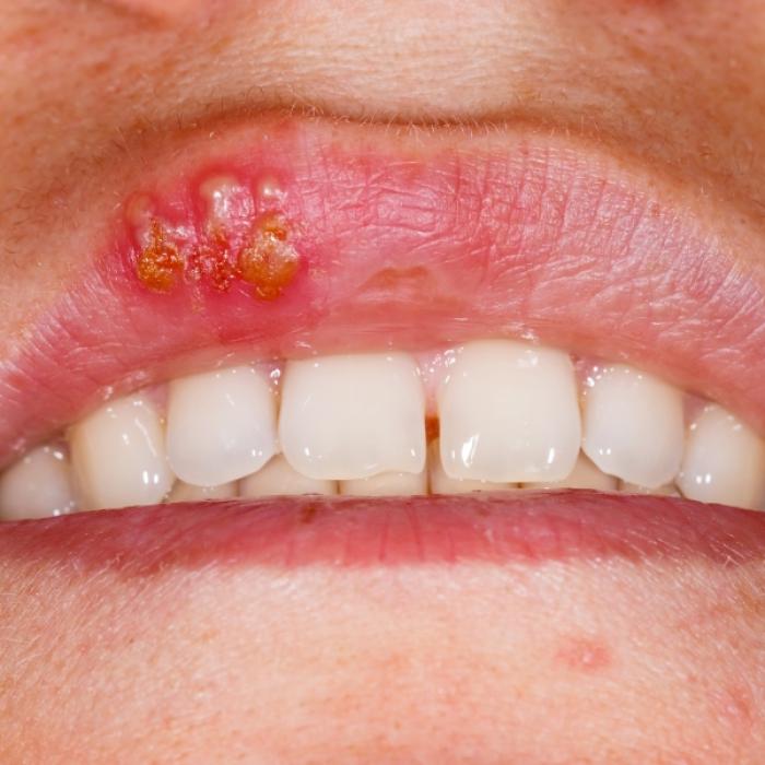 Virus in Senioren-Gehirnen gefunden! Löst Herpes Alzheimer aus?