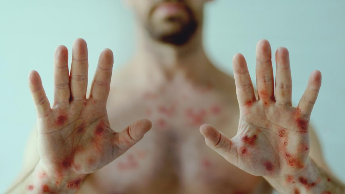 Einem 40-j&auml;hrigen Patienten verrottete die Nase, nachdem eine Affenpocken-Infektion nicht rechtzeitig erkannt worden war (Symbolfoto). (Foto)