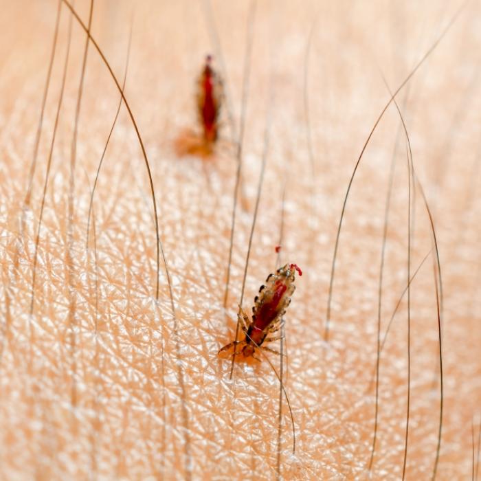 Läuse-Horror! Parasiten saugten Mädchen (4) fast tot