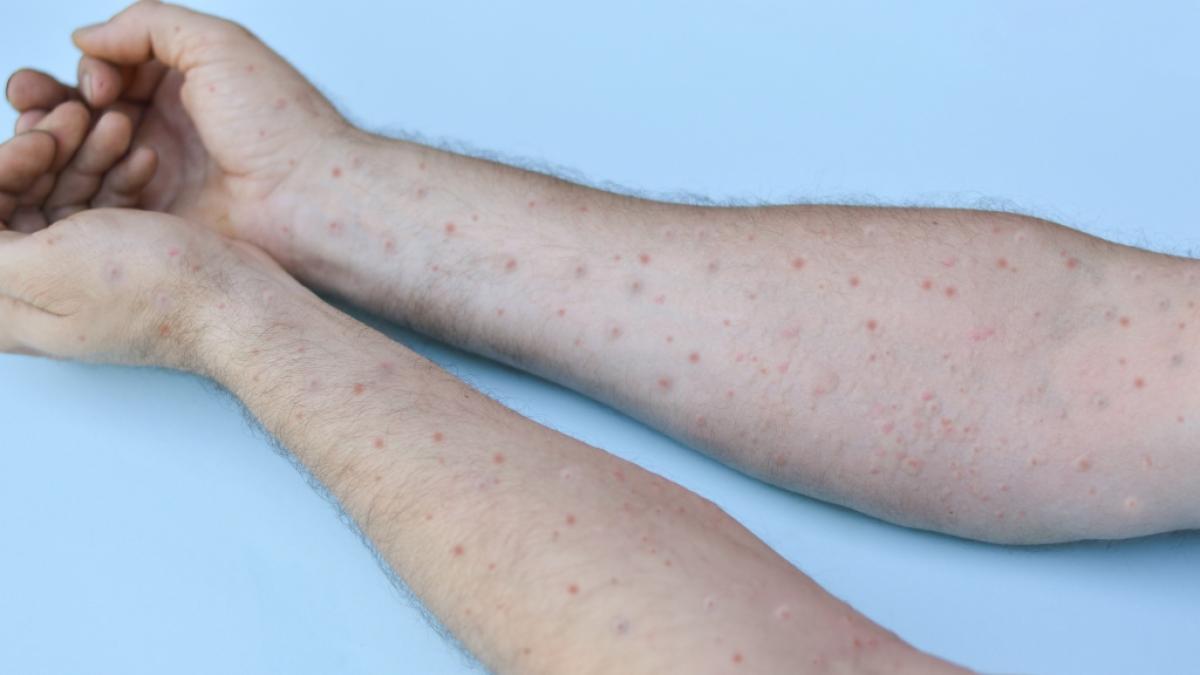 Nach dem Coronavirus und den Affenpocken entdeckten Wissenschaftler nun die Tomatengrippe. (Foto)