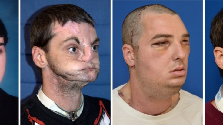 Richard Lee Noris verlor bei einem Unfall sein Gesicht. Nach einer aufwendigen Operation trägt er nun das Gesicht eines Toten.