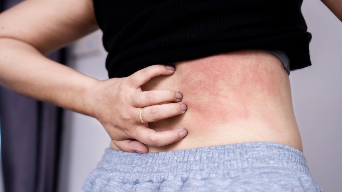 Ausschlag am R&uuml;cken kann von einer hMPV-Infektion stammen. (Symbolfoto) (Foto)