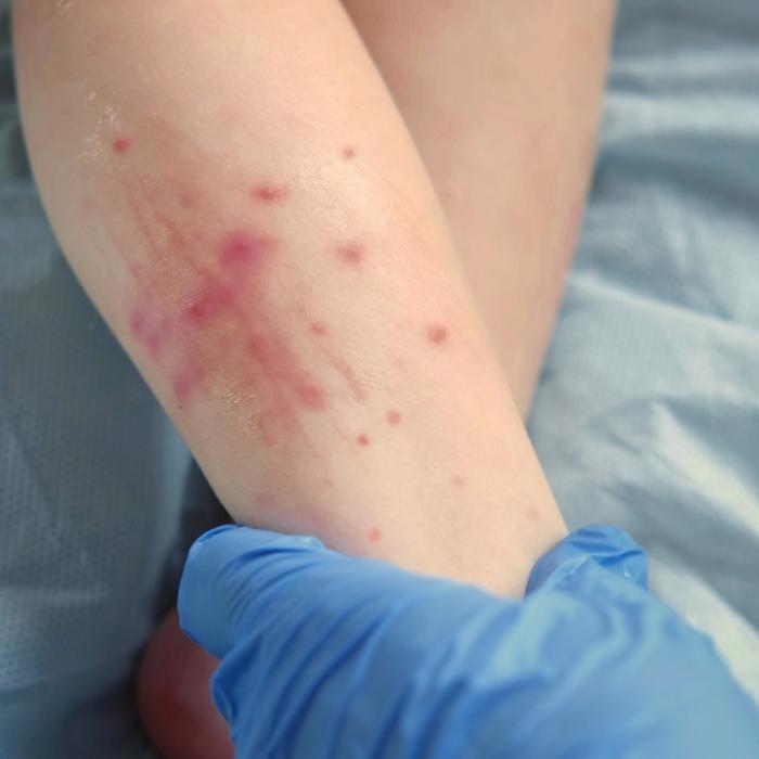 Neuer Mpox-Stamm entdeckt - 10 Prozent der Infizierten sterben