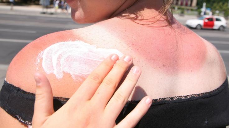 Schon im Frühling kann die Sonne ungeahnte Kräfte entwickeln - Sonnenbrand ist oft die schmerzhafte Folge.