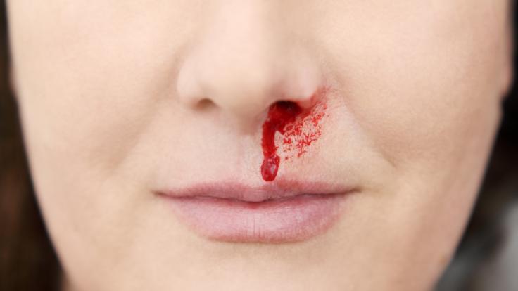 Eine Frau hatte Nasenbluten. Wenig später verlor sie ihr Gedächtnis. (Symbolfoto)