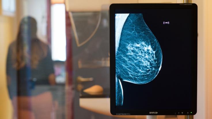 Ersetzt der Bluttest bald die Mammographie?