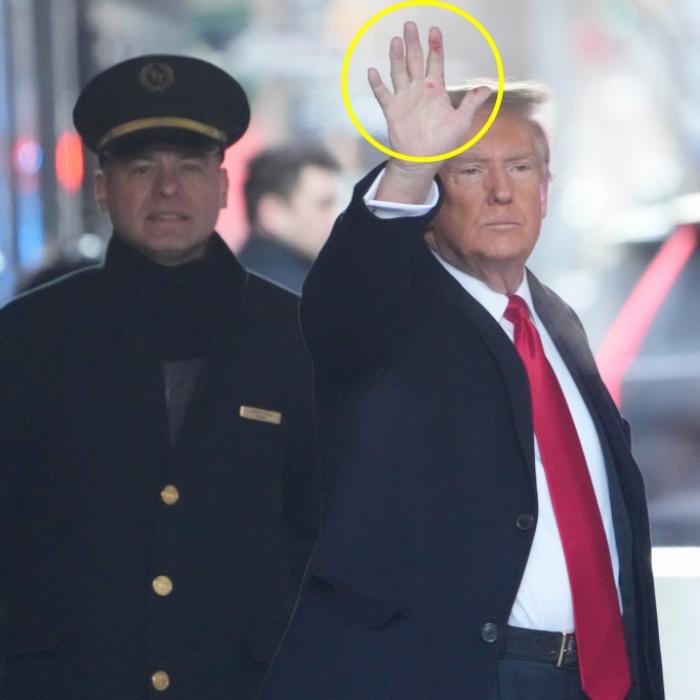 Mysteriöse Flecken an den Händen! Leidet der Ex-Präsident an Syphilis?