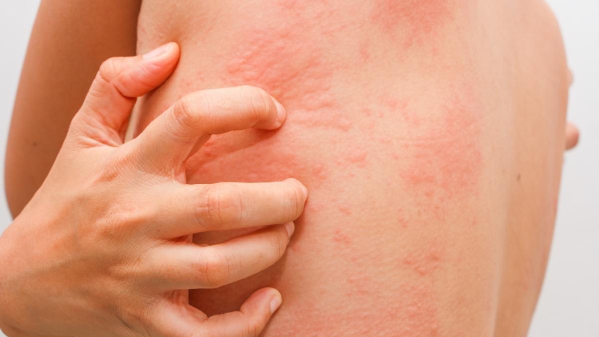 Einer spanischen Studie zufolge k&ouml;nnten Hautver&auml;nderungen noch vor dem Ausbruch klassischer Symptome auf eine Coronavirus-Infektion hinweisen (Symbolbild). (Foto)