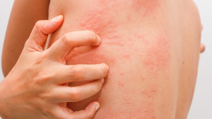 Einer spanischen Studie zufolge könnten Hautveränderungen noch vor dem Ausbruch klassischer Symptome auf eine Coronavirus-Infektion hinweisen (Symbolbild).