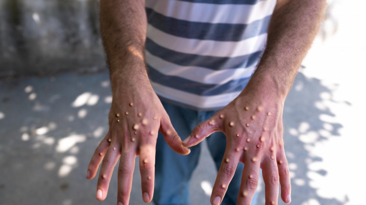 Mpox breiten sich in Europa erneut aus. (Foto)