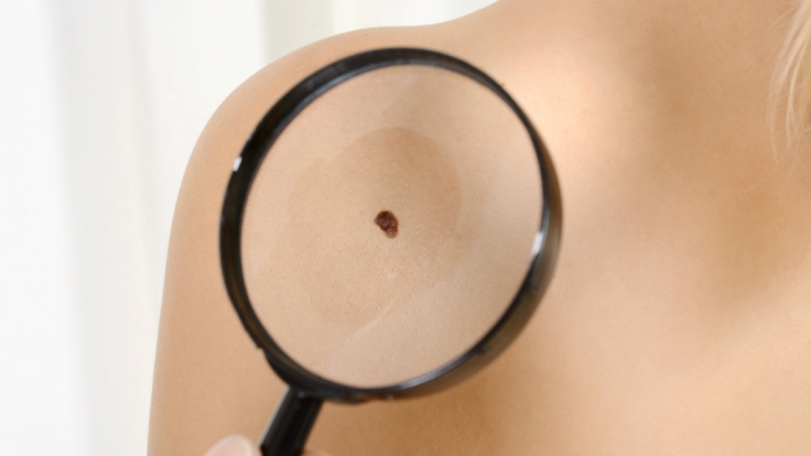 Im Zweifelsfall lieber zum Dermatologen: Er kan abklären, ob es sich um Hautkrebs handelt.