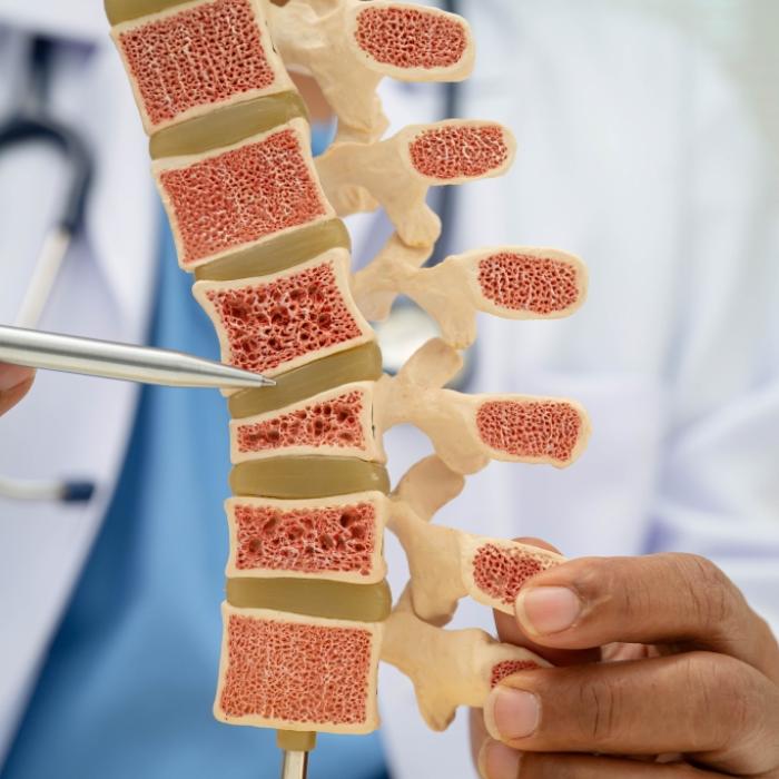 Experte erklärt, welche Osteoporose-Warnzeichen oft ignoriert werden