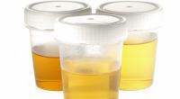 Die Farbe des Urins verrät so einiges über die menschliche Gesundheit.