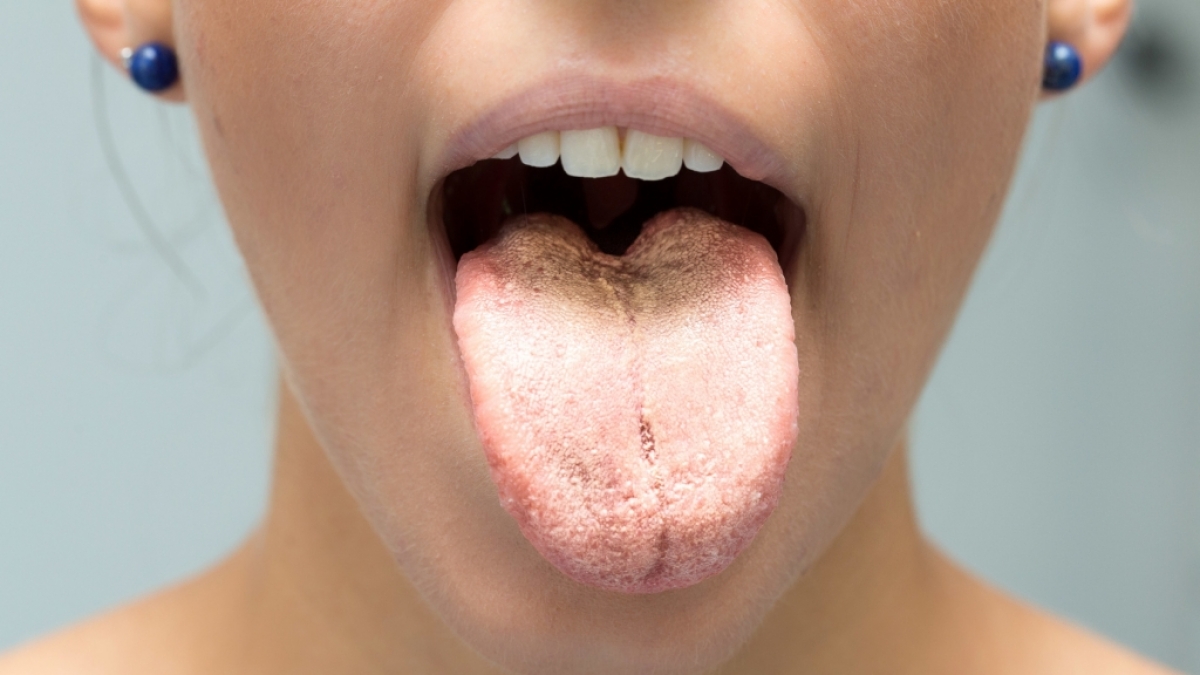 Das Aussehen der Zunge verr&auml;t eine Menge &uuml;ber unsere Gesundheit. (Foto)