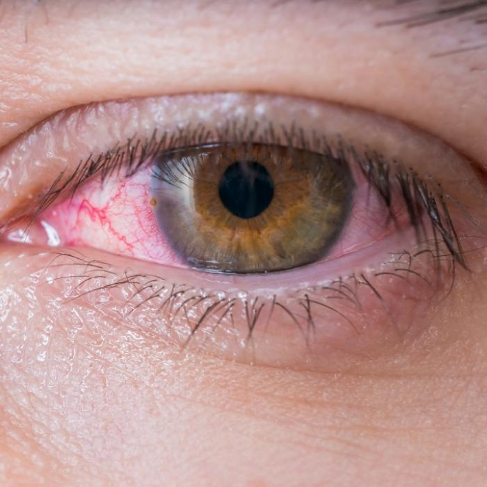 Ekelfund! Ärzte ziehen 15-Zentimeter-Parasit aus Auge