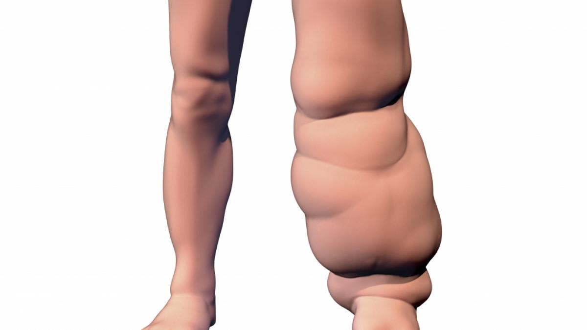 Mahogany Geter will trotz Lymph&ouml;dem Model werden. (Symbolbild) (Foto)