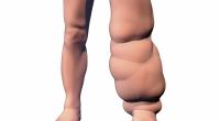 Mahogany Geter will trotz Lymphödem Model werden. (Symbolbild)