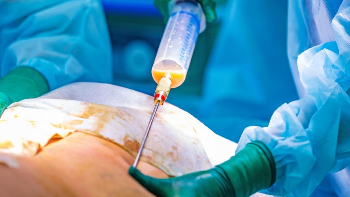 Der Traum von einem straffen Bauch wurde f&uuml;r eine Krankenschwester in Mexiko zum Todesurteil (Symbolfoto). (Foto)
