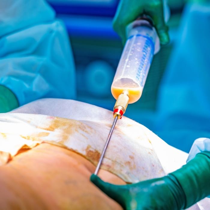 Fettabsaugung auf eigene Faust geht schief - Krankenschwester (30) tot