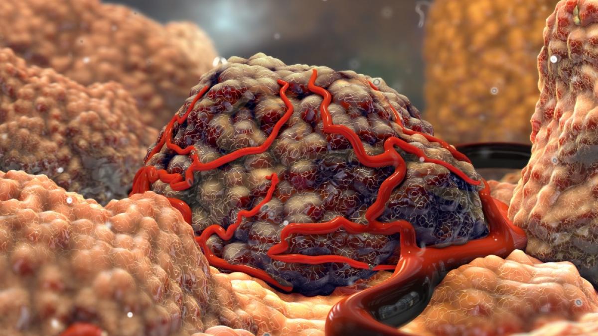 &Auml;rzte haben einem Baby einen gigantischen Tumor entfernt. (Foto)