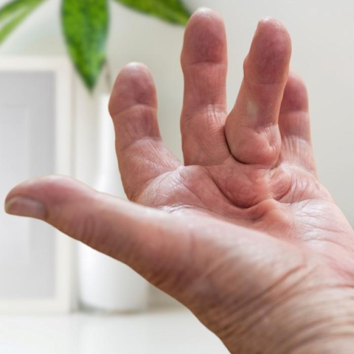 Woher kommen Knoten oder Schwellungen auf den Handflächen?