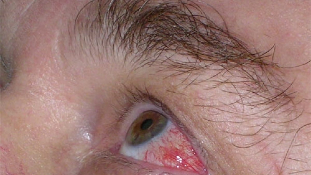 Die Entz&uuml;ndung der Blutgef&auml;&szlig;e ist eine Erkrankung, die sich &uuml;berall im K&ouml;rper auspr&auml;gen kann - auch an den Augen. (Foto)