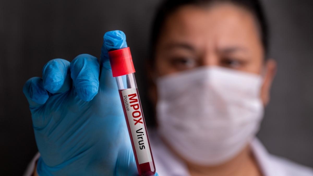 Die gef&auml;hrliche Mpox-Variante Klade 1b breitet sich in Europa aus. (Foto)