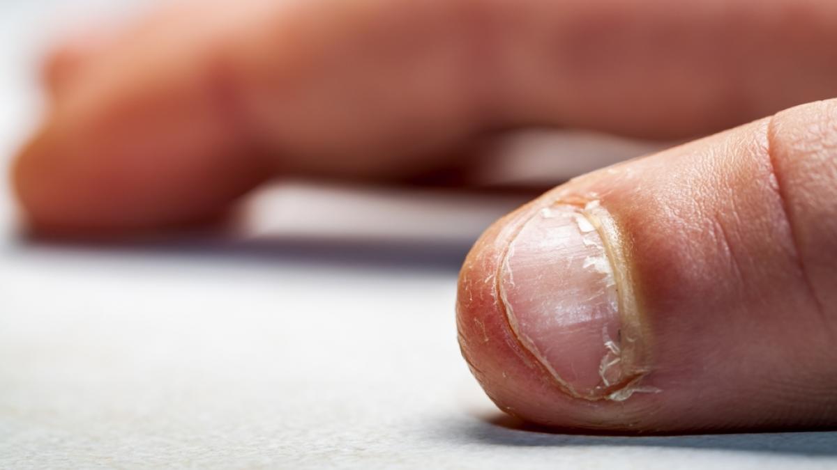 N&auml;gelkauen ist mehr als eine l&auml;stige Angewohnheit und kann sogar t&ouml;dlich enden (Symbolfoto). (Foto)