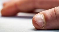 Nägelkauen ist mehr als eine lästige Angewohnheit und kann sogar tödlich enden (Symbolfoto).