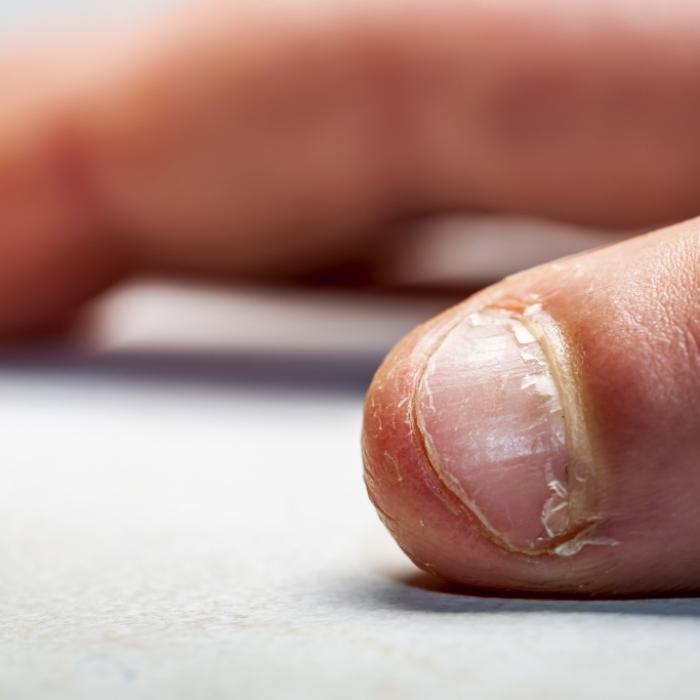 Mann knabbert Fingernägel - und ringt mit dem Tod