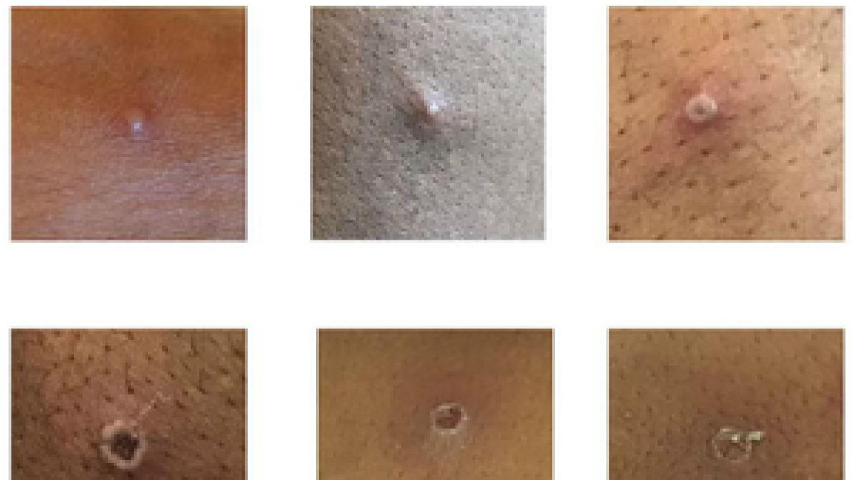 Das von der UK Health Security Agency (UKHSA) zur Verf&uuml;gung gestellte Bild zeigt Hautl&auml;sionen bei Patienten, bei denen Affenpocken nachgewiesen wurden. (Foto)