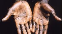 Dieses Bild zeigt die Handflächen eines Affenpockenpatienten aus Lodja, einer Stadt im Katako- Kombe Health Zone, der Demokratischen Republik Kongo.