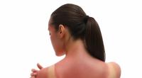 Erste Hilfe bei Sonnenbrand: Nicht jede Creme hilft (Symbolfoto).