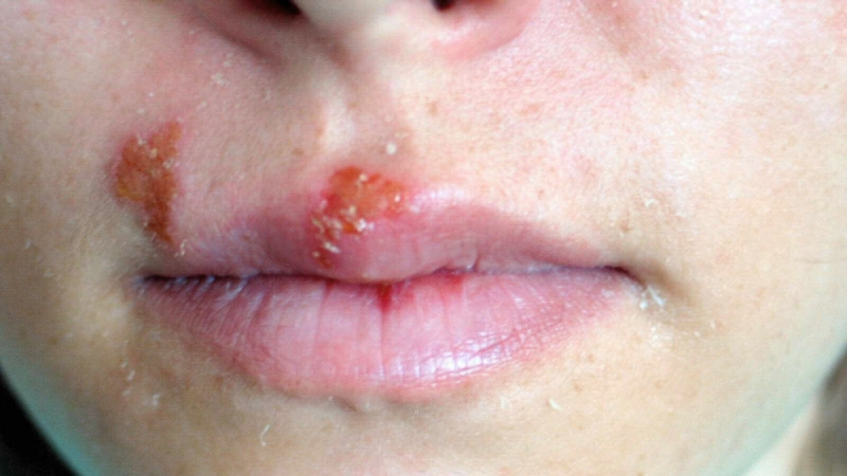 Erst ein leichtes Jucken, doch ein paar Stunden sp&auml;ter haben Herpesbl&auml;schen die Lippe fest im Griff. (Foto)