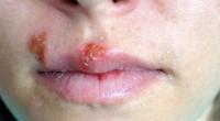 Erst ein leichtes Jucken, doch ein paar Stunden später haben Herpesbläschen die Lippe fest im Griff.
