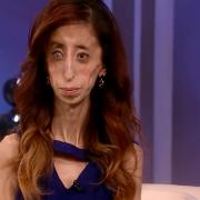 Texanerin Lizzie Velasquez hat null Prozent Körperfett.