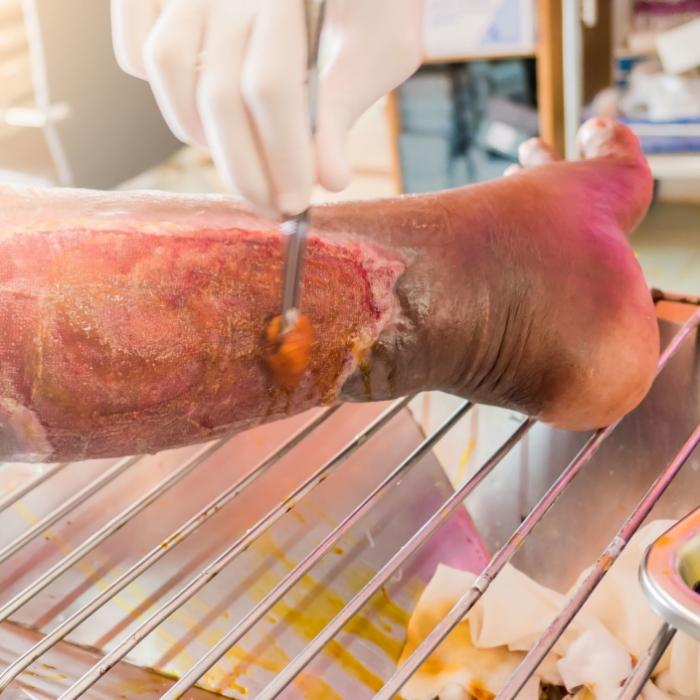 Verfault bei lebendigem Leib! Diese Krankheit ist tödlich