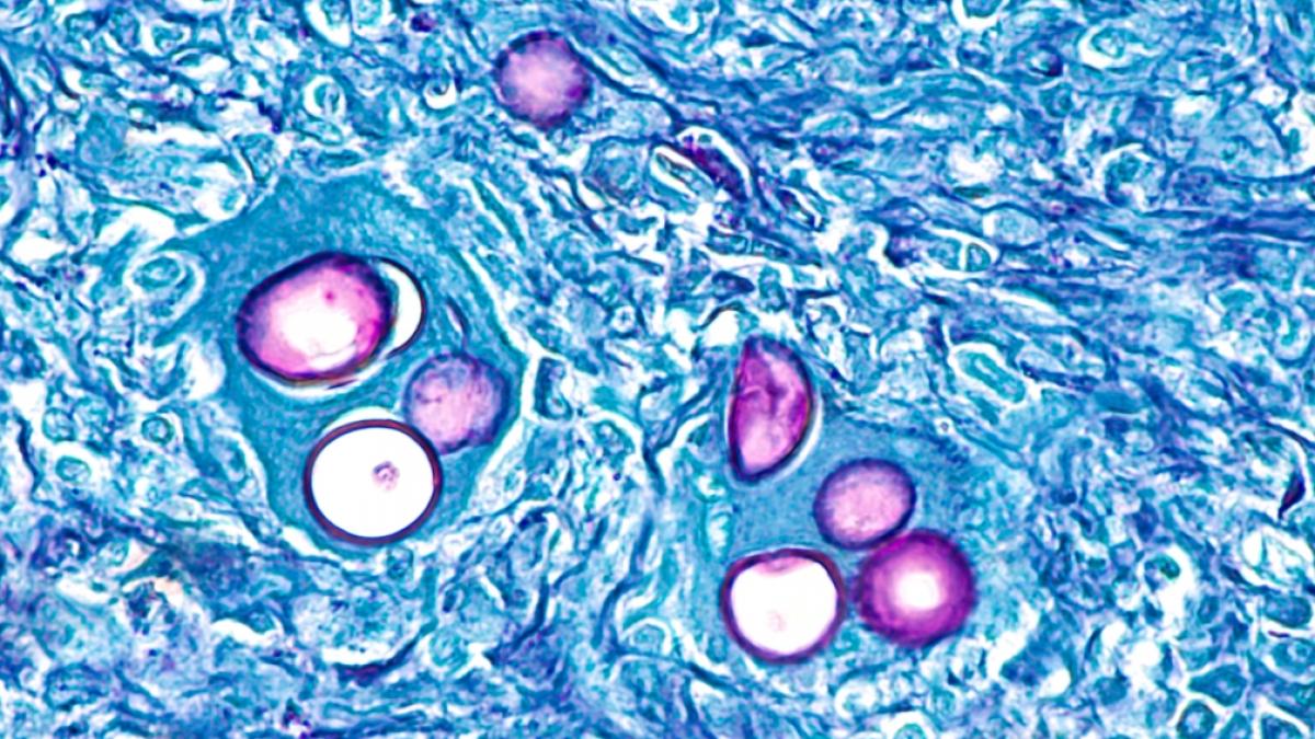 Mikroskopische Aufnahme zeigen Coccidiosis immitis. (Foto)
