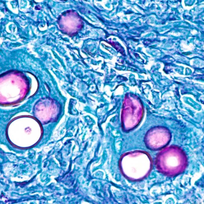 Ärzte warnen vor Pilz-Fieber - Potenziell tödliche Infektion breitet sich aktuell aus