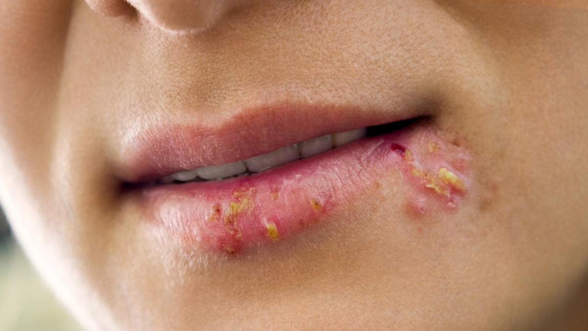 Eine vollst&auml;ndige Heilung von Herpes ist bisher unm&ouml;glich. (Foto)