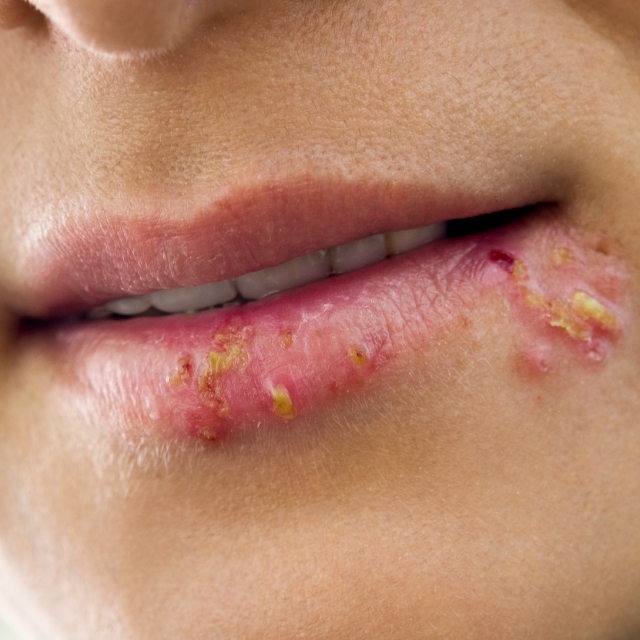Gibt es bald eine Impfung gegen Genitalherpes?