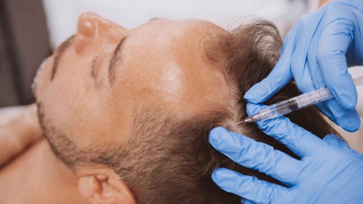 In Istanbul kam ein Mann offenbar w&auml;hrend einer Haartransplantation ums Leben. (Foto)