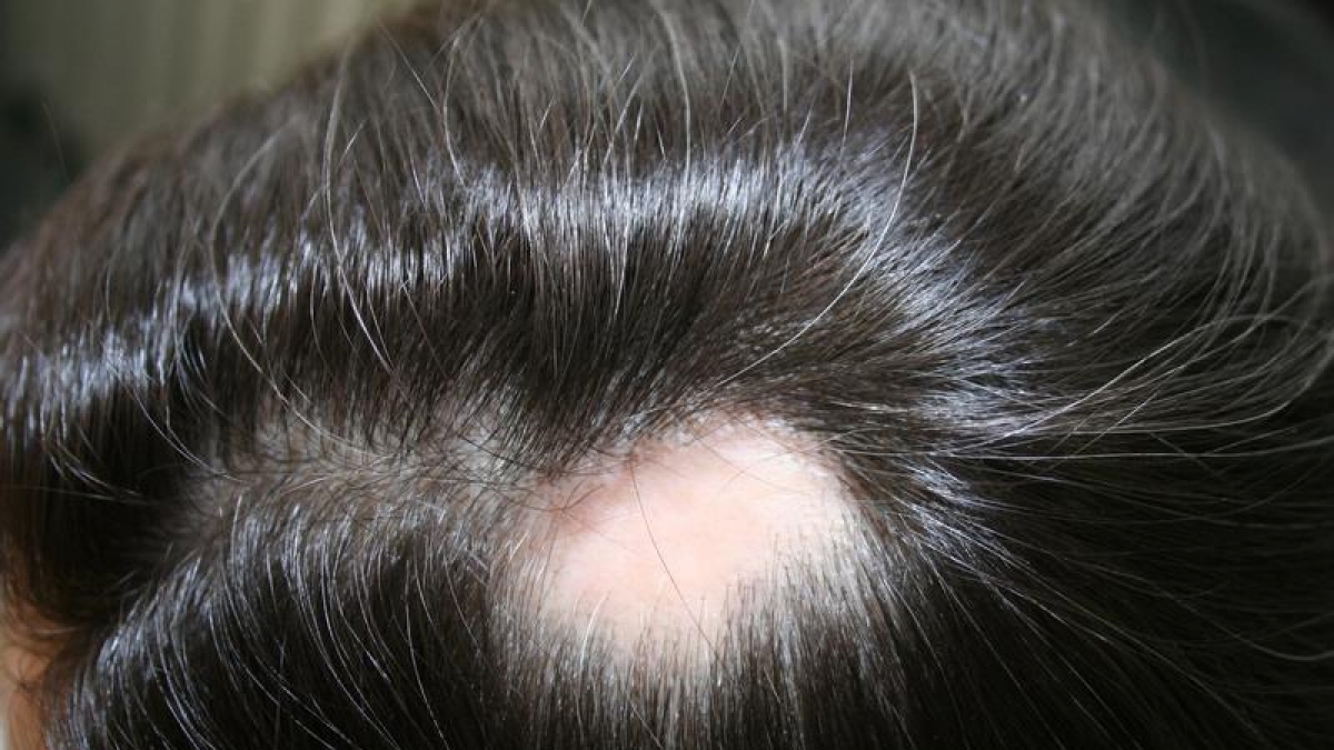 Die Alopecia areata hat ein typisches Aussehen: Die haarlosen Kreise sind scharf abgegrenzt. (Foto)