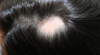 Die Alopecia areata hat ein typisches Aussehen: Die haarlosen Kreise sind scharf abgegrenzt.