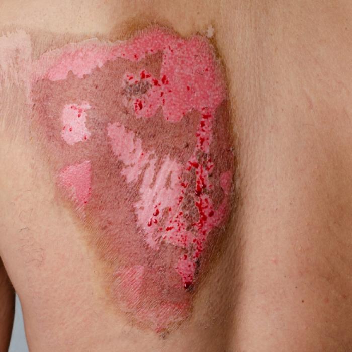 Verstümmelter Teenager sammelt Spenden für Herzenswunsch-OP