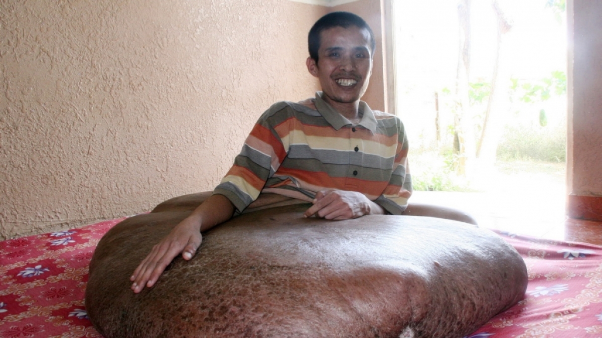 Der krebskranke Vietnamese Nguyen Duy Hai sitzt am 15.06.2011 in seinem Haus in Da Lat (Vietnam) und zeigt seinen Tumor. (Foto)