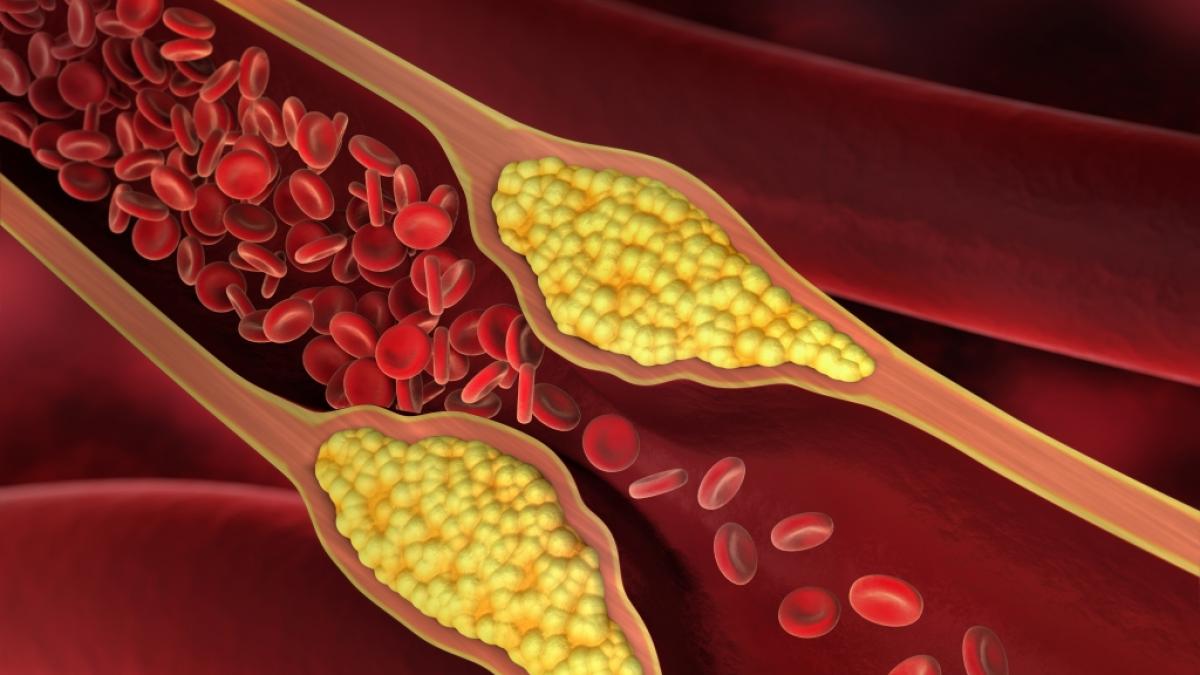 Jeder dritte Deutsche hat einen &uuml;berh&ouml;hten Cholesterinspiegel. (Foto)